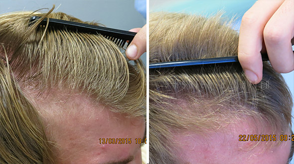 Case Study: Ashley and Martin Brisbane Patient Sees Hair Loss Results «  Ashley and Martin Brisbane